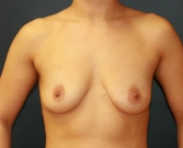 Feel Beautiful - Breast Augmentation San Diego Case 48 - Before Photo